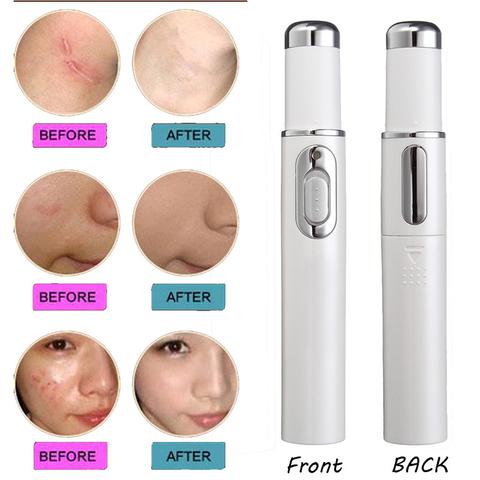 STORAZONE Makeup Blue Light Therapy Acne Laser Pen Soft Scar Wrinkle Removal Treatment Device Skin Care Beauty Equipment