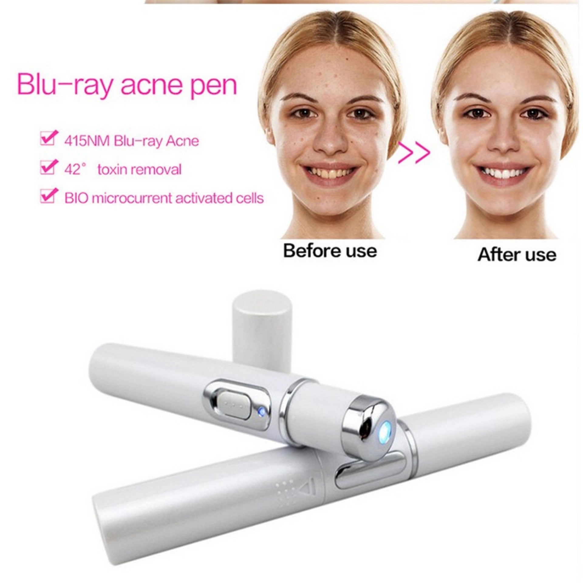 STORAZONE Makeup Blue Light Therapy Acne Laser Pen Soft Scar Wrinkle Removal Treatment Device Skin Care Beauty Equipment